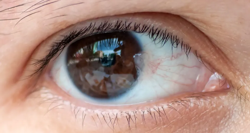 Close-up of an eye with a pterygium growing onto the cornea